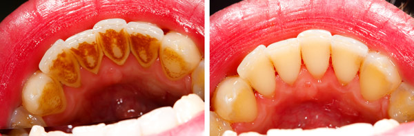 Vor und nach Zahnsteinbehandlung